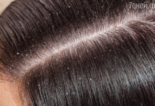 Photo of Как предотвратить перхоть у шартрезов?